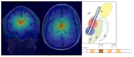 ATN 자극 (전극 –2+3) 시 internal electrical field의 변화 (좌, 중) 및 ATN 과 DBS 전극 3차원 위치 모식도 (우상) 와 DBS 전극 (우하)