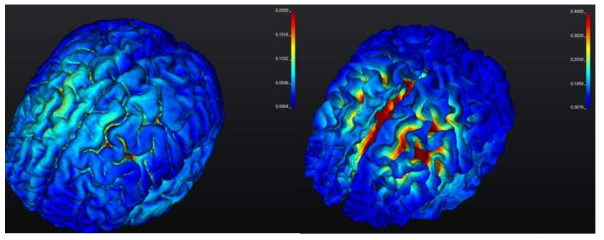 ATN 자극 (전극 –2+3) 시 cortical electrical field의 변화 시뮬레이션 매핑. (좌) 5Hz 자극 후, (우) 130Hz 자극: high frequency 자극 시 동조되는 뇌영역이 유의하게 넓어지는 패턴이 일정하게 관찰됨