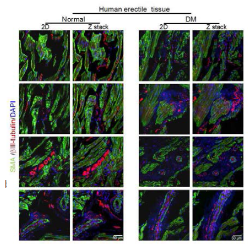 Decrease in the expression of a neuronal marker in the penis of a diabetic patient with erectile dysfunction. Images of transverse thick-cut (20 μm) sections depicted by βIII-tubulin (a neuronal marker, red) and smooth muscle α-actin (SMA, a smooth muscle cell marker, green) staining. Thickness of each stack is 15 μm and 16 images were used for three-dimensional reconstruction. DAPI = 4,6-diamidino-2-phenylindole (a nuclei marker, blue). DM = diabetes mellitus