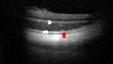 배아줄기세포 유래 망막색소상피세포 및 배아줄기세포 유래 시각세포전구체 망막하 주사 22일 후 촬영한 빛간섭단층촬영 영상(optical coherence tomography, OCT