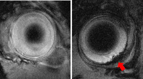 좌. 정상 Brown-Norway 랫트의 9.4T T2* 강조 기울기에코 MRI, 우. SPIO 세포표지 된 신경전구체세포(neural precursor cell) 망막하 이식 후 촬영 한 MRI