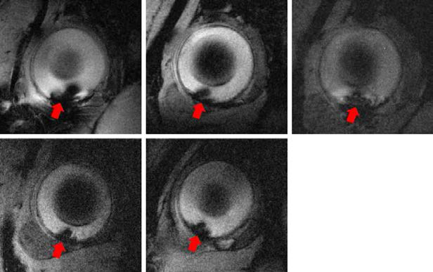 좌상. SPIO 입자를 표지한 망막시각세포를 망막하 이식할 경우 SPIO 세포표지된 망막세포를 RCS 랫트에 망막하 이식 다음날 촬영한 9.4T T2* 강조 기울기에코 MRI에서 감소된 신호강도(signal void)가 관찰된다. 이식 2주후 (중상), 4주후 (우상), 8주후 (좌하), 12주후 (중하), 20주후 (우하) 촬영된 MRI에서 감소된 신호강도가 유지되는 것이 관찰