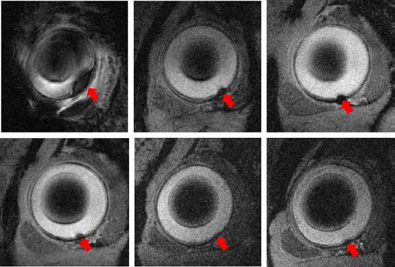 좌상. SPIO 입자를 포함한 세포 배양액을 망막하 이식할 경우 SPIO 세포표지된 망막세포를 RCS 랫트에 망막하 이식 다음날 촬영한 9.4T T2* 강조 기울기에코 MRI에서 감소된 신호강도(signal void)가 관찰된다. 이식 2주후 (중상), 4주후 (우상), 8주후 (좌하), 12주후 (중하), 20주후 (우하) 촬영된 MRI에서 감소된 신호강도가 점점 줄어드는 것이 관찰