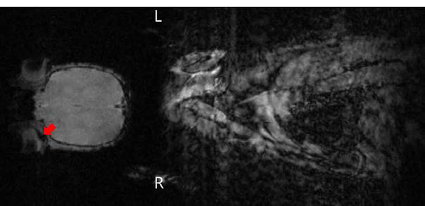 상. SPIO 세포표지된 세포를 BN 랫트에 망막하 이식 후 전신 9.4T T2* 강조 기울기에코 MRI를 촬영