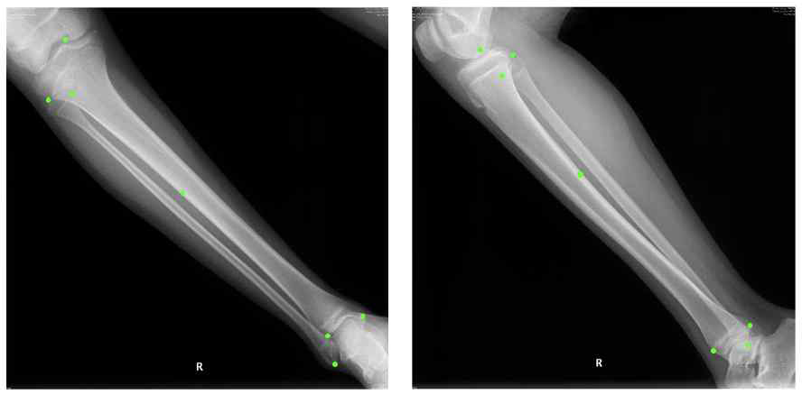 사용자로부터 입력 받은 X-ray 상의 점