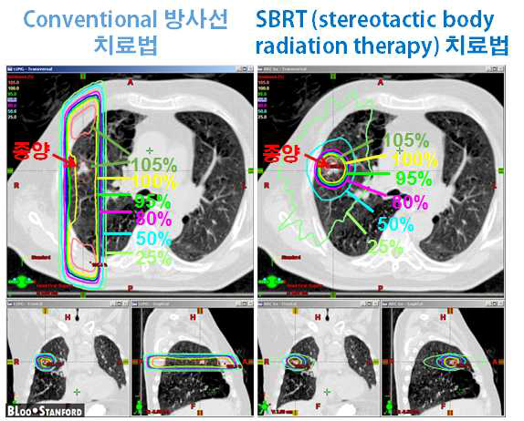 기존의 방사선 치료법(왼쪽)과 체부정위방사선치료 (오른쪽)의 흉부 내 방사선 isodose 분포도. Stanford 대 Bill Loo 교수 제공