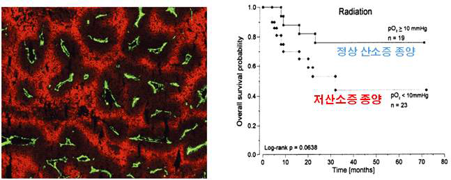 왼쪽: 종양 내 저산소증 부분 (붉은색 - EF5로 면역염색된 종양 내 저산소증 부분)과 종양 혈관 (초록색 - CD31으로 염색). From Biology of Cancer, Weinberg, 2007. 오른쪽: 방사선 치료를 받은 자궁경부암 환자의 survival plot. 종양 내 산소 분압은 Eppendorf polarographic probe으로 측정됨. Hockel et al., 1996