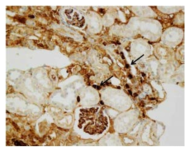 Folic acid 주입으로 인한 사이질 섬유화에서 LOXL2 발현의 증가