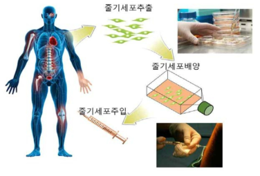 일반적 성체줄기세포 치료과정