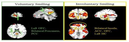 자발적, 비자발적 웃음 조건에서 활성화되는 영역들