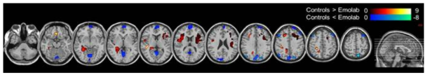 감정노동군에서 지엽적 동기화가 증가된 뇌 영역들(파란색)과 감소된 뇌 영역(붉은색)