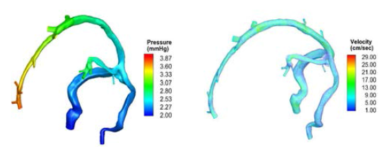 Patient-specific cerebral vein model의 압력구배 및 속도장 패턴