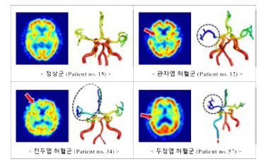 정상군 및 뇌허혈 환자군의 뇌혈관 모델 시뮬레이션 값과 SPECT 임상 데이터 비교를 통한 임상검증