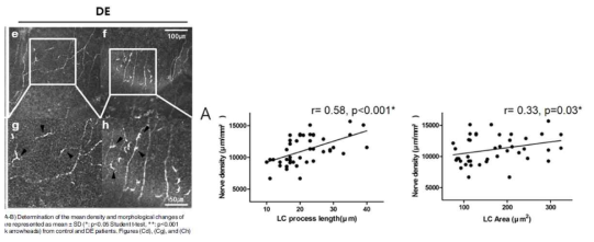 (왼쪽) 건성안 환자의 각막 in vivo confocal microscopy를 통해 lacrimal gland와 corneal nerve사이의 interaction이 증가되어 있음을 확인함. LC process의 길이 및 면적과 nerve density 가 양의 상관관계를 갖고 있음을 확인한 그림