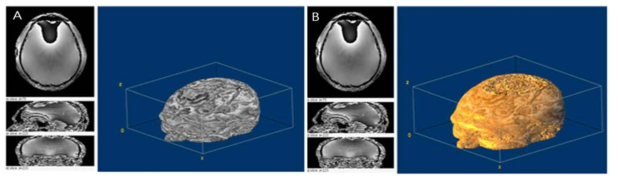 (A) Phase image를 획득하여, 다음과 같이 image volume화를 진행하였으며, 기존 QSM 모듈과 다른 대뇌 calcification 확인함. (B) Phase image를 반전하여, 다음의 color 구조를 확립하고, 그후 calcification 부분의 density를 calibration 진행함