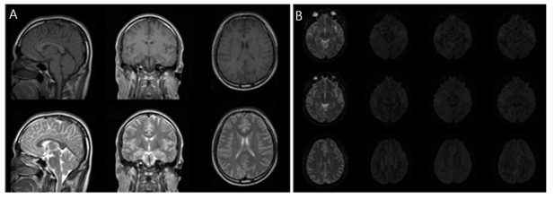 (A) 최적화된 MRI 프로토콜 사용하여 Philips 3T MRI System에서 획득한 고해상도 3차원 T1, T2 강조 MRI 해부학적 영상. (B) 3T MRI System에서 획득한 고해상도 3 차원 T1, T2 강조 MRI에 정합된 SWI/QSM 대사영상