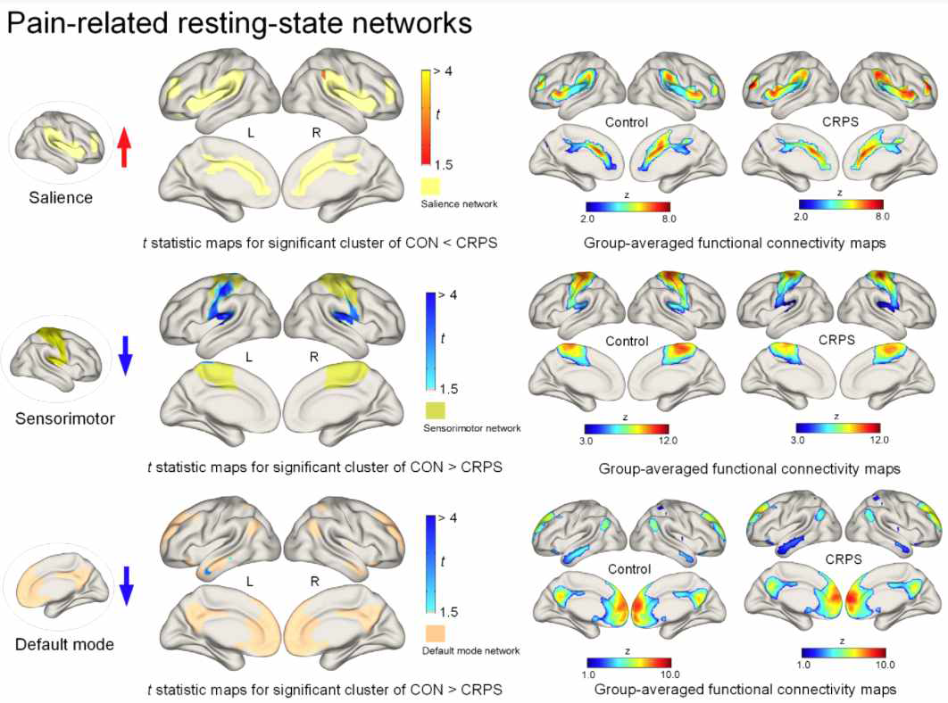 복합부위통증 증후군 환자군의 정상군 대비 뇌 네트워크 특성 통계 맵