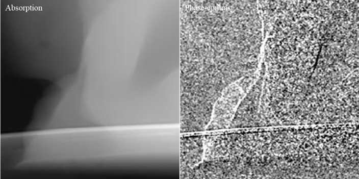 Single grid를 사용한 닭 가슴살 팬텀의 흡수 x-선 영상과 위상대조영상의 확대영상 비교: (左)흡수 x-선 영상, (右)위상대조 영상