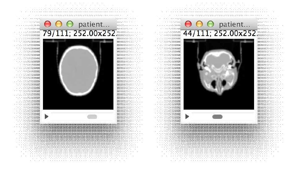 mhd format 의 Head&Neck CT image phantom 샘플