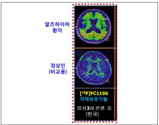 [18F]FC119S를 이용한 임상시험 결과