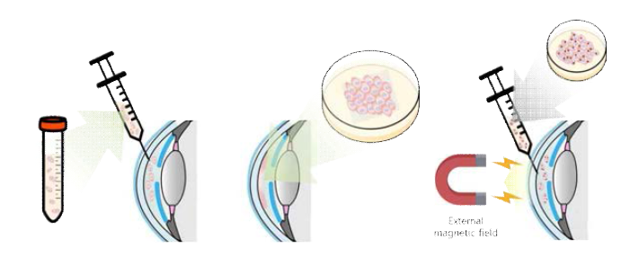 기존에 사용된 각막내피로의 세포전달방법: 전방 내 세포 주사 (좌), 인조각막내피조직의 수술적 방법을 통한 이식 (중), 자성나노입자가 담지된 세포를 자력유도에 의해 각막내피로 유도 (우)