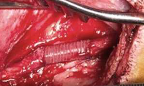 실험동물의 경동맥에 이식된 인공혈관의 모습