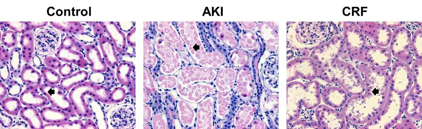 Results of histopathological findings for kidney. In histopathological findings with hematoxyln and Eosin stain, destructive tubule and edematous renal tubular cells were noted in AKI group and increased number and detachment of renal tubular cell nuclei in CRF group compared with that of controlCRF