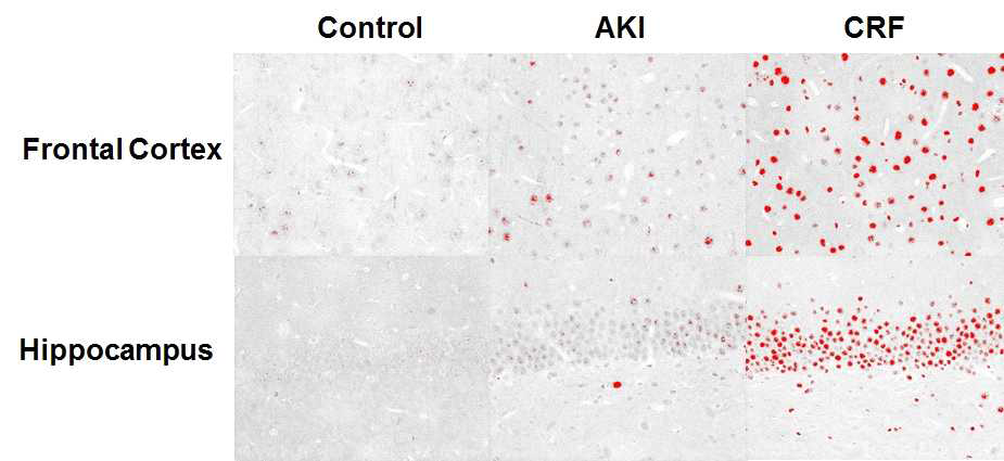 Results of immunostaining for NF-κB. Significantly increased expression of NF-κB was noted in CRF comparing with that of AKI and controlCRF