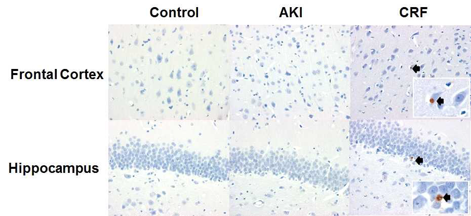 Results of TUNEL staining, cell death was noted (arrow) in only CRF but not in AKI and controlCRF