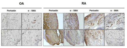 OA와 RA 활막조직의 페리오스틴과 α-SMA와 면역조직염색