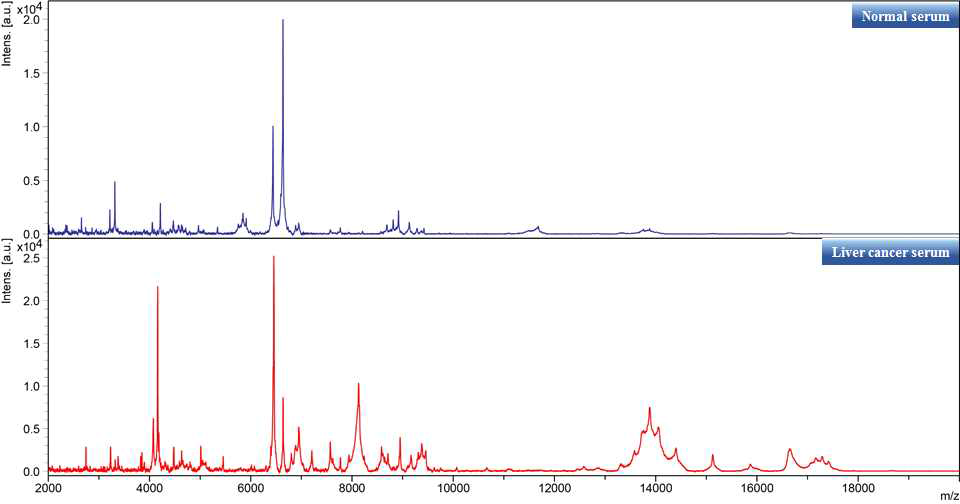 일반인 혈청(위)와 간암 환자의 혈청(아래)으로부터 추출한 단백질의 MALDI-TOF MS 스펙트럼