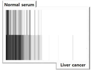 비간암-간암 환자 혈청의 MALDI-MS 프로파일의 바코드변환