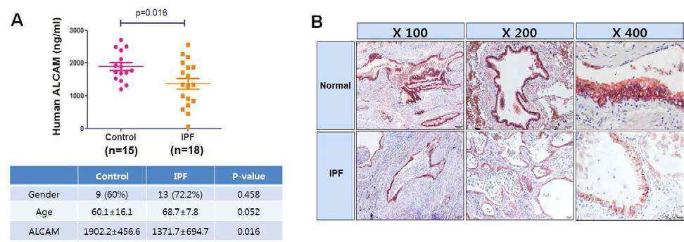 특발성 폐 섬유증 환자에서 ALCAM 발현이 감소. 대조군 및 특발성 폐 섬유증(IPF) 환자의 (A) 객담 내 ALCAM 수준을 ELISA로 평가 하였다. (B) 대조군과 IPF 환자의 폐 조직에서 ALCAM에 대한 대표적인 면역 조직 화학 염색