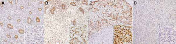 Expression levels of γ-H2AX protein in tissue samples of eutopic and ectopic endometrium of patients with or without endometriosis. (A) Eutopic endometrium of control group: γ-H2AX expression is absent or very faint in the stromal cells. (B) Eutopic endometrium of endometriosis group: Patchy γ-H2AX expression with variable staining intensity is observed. Most of the stromal cells show moderate nuclear γ -H2AX immunoreactivity. (C) Ectopic endometrium of endometriosis group: The stromal cells demonstrate uniform and strong γ-H2AX immunoreactivity. γ-H2AX expression status in the glandular epithelium is not different between the control and endometiosis groups. (D) Normal ovarian stroma: γ-H2AX expression is absent in normal ovarian stroma. Original magnification: A-D, ×100; inset, ×400