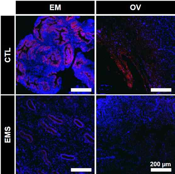 Immunofluorescence staining of BRCA1 in eutopic endometrium and ovary of the patients with and without endometriosis. CTL-EM, eutopic endometrium of patients without endometriosis; EMS-EM, eutopic endometrium of patients with endometriosis; CTL-OV, Non-endometriotic ovarian tissue; EMS-OV, ovarian endometriotic cyst