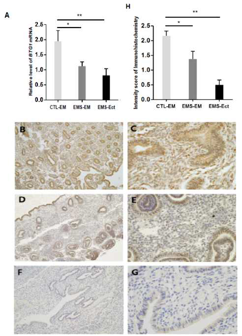 Expression levels of BTG1 protein and mRNA in tissue samples of eutopic and ectopic endometrium ofpatients with and without endometriosis. (A) Different BTG1 mRNA expressions between eutopic andectopic endometrial tissue of patients with and without endometriosis. BTG1 mRNA expressions between endometrium of patients with and without endometriosis and ectopic endometrium. N = 4; *, P< 0.05; **, P < 0.01. (B) Eutopic endometrial tissue shows uniform and strong BTG1 immunoreactivity in the glandular and stromal cells (×100). (C) High-power view of image B. The cells in the endometrial glands and stroma exhibit strong BTG1 expression both in the nucleus and cytoplasm (×400). (D) Eutopic endometrial tissue of a patient with endometriosis displays patchy BTG1 expression with variable staining intensity (×100). (E) High-power view of image D. About half of the endometrial glandular epithelium and stromal cells show weak-to-moderate nuclear and cytoplasmic BTG1 immunoreactivity (×400). (F) Ectopic endometrial tissue in a patient with endometriosis (×100). (G) High-power view of image F. BTG1 expression is absent in the ectopic endometrial tissue. A faint nonspecific cytoplasmic staining is observed in the glandular epithelium (×400). (H) Immunohistochemical analysis of BTG1 protein expression levels in eutopic endometrium of patients with (N = 8) and without (N = 19) endometriosis and ectopic endometrium of patients with endometriosis (N = 10). *, P < 0.05; **, P < 0.01. Results are presented as mean ± SEM. EMS-EM, endometrium of the patients with endometriosis; CTL-EM, endometrium of thepatients without endometriosis; EMS-Ect, ectopic endometrium of the patients with endometriosis