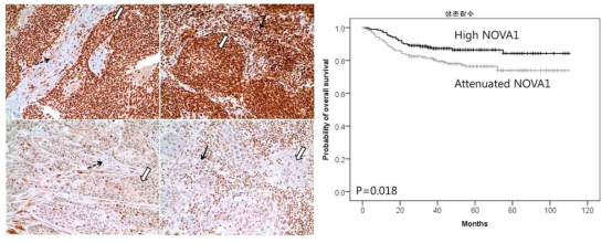 두경부편평상피세포암의 종양세포와 기질세포 및 면역세포에서 강한 NOVA1 발현을 보이는 예 (위), NOVA1 발현이 감소하는 예 (아래). 종양세포에서 NOVA1 발현이 감소하는 경우, 나쁜 생존률과 상관성을 보임