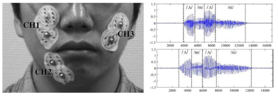 근전도 음성 합성을 위한 바이폴라 전극의 위치(좌), 합성음(우하)과 원 음성(우상)