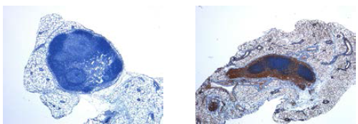 GFP 염색의 현미경적 소견 (x40). 대조군 (좌) 에 비하여 갈색으로 염색된 GFP 를 포함하는 세포들이 nude mice에서 적출한 림프절에서 보이고 있다 (우, SNU-228). 갈색으로 염색된 세포들은 GFP tagging 된 immortal cell line을 시사함