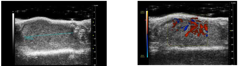 SNU-349 5x105 cells/50㎕ 주입 개체의 22주 초음파 사진. VEVO 22MHz 초음파를 사용하였음. 과혈관성을 보이지만 신실질로의 침습이 없는 피막을 따라 자라는 종괴로 관찰됨