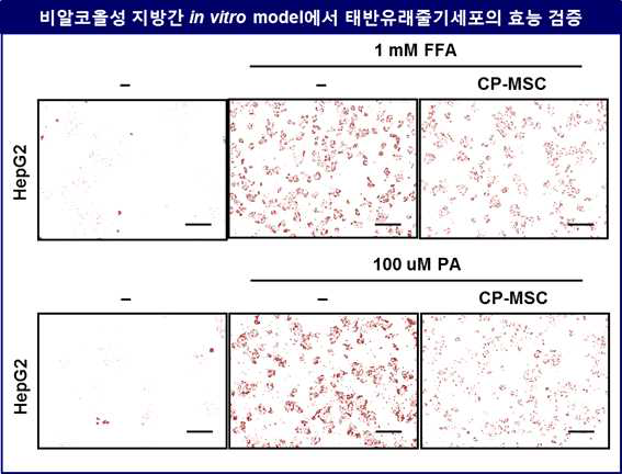 비알코올성 지방간에서 태반 유래줄기세포의 in vitro 효능 분석