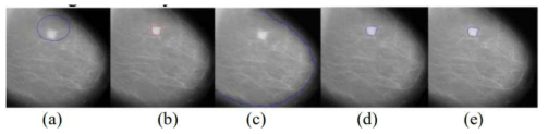 영상 분할 결과 : (a) 원본 이미지 (b) Ground Truth (c) 기존 Chan-vese’s model (d) 기존 Zhang’s model (e) 영상 분할 결과