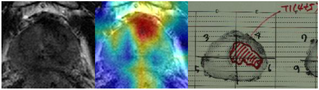 76세 남자 환자의 T2강조 전립선 MR 영상(좌), CNN 으로 분류시의 activation map(중), 병리 mapping sheet(우). 전립선 전좌측 전이구역에 주변보다 어두운 신호강도의 병변 의심 부위가 있고, 인공지능은 이 부분에 activation map을 표시하면서 cancer 가 있는 병변의 가능성을 시사하였다. Activation map 이 표시한 부분과 실제 병리소견이 잘 일치하는 것을 볼 수 있다