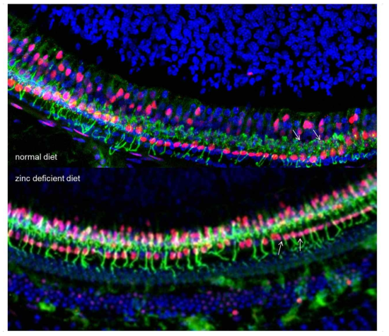 Ribbon synapse in the mice with noise exposure. In the control mice, ribbon synapse could be found (upper panel, arrows). However, it is difficult to find a ribbon synapse in mice with zinc-deficient diet (lower panel, arrows)