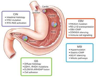 TCGA에서 발표한 새로운 위암 molecular classification. TCGA에서는 위암 특이적 molecular characteristics에 근거하여 위암을 4종류로 분류함