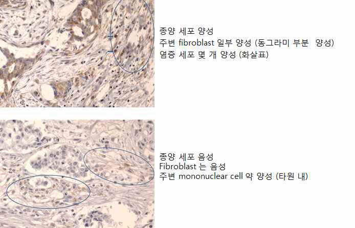종양 세포 및 종양미세환경 내 간질세포에서의 MMP11 발현 면역 조직화학 결과