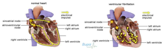 정상적인 심장리듬(좌)과 부정맥(우)의 전기전달