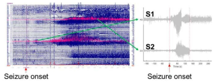 뇌전증 발작의 시작 및 전파에 따른 두 신호 채널 S1과 S2의 선택