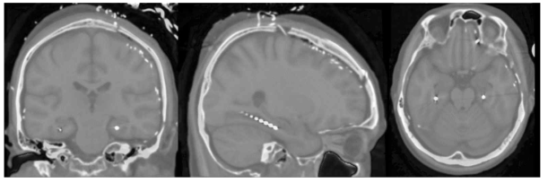 해마에 삽입된 심부 뇌파 전극 registration image