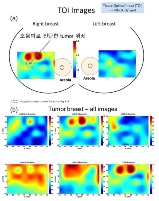 국제 공동 임상 실험을 통해 한국 여성 유방암 환자에서 측정된 조직 광학지수(TOI) 영상과 tumor 부근에서의 진단 영상